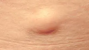 lump-skin-Diseases