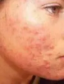 acne