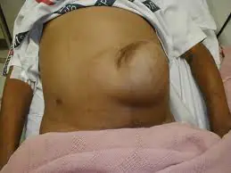 Hernia