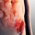 فتق در اینجا اصلاح می شود