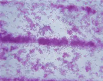 tuberculosis