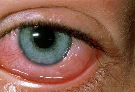 Allergic-problems -eyes-red-مکالمه انگلیسی با موضوع حساسیت چشمی