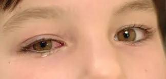sore eyes